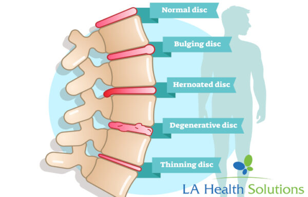 What Is Degenerative Disc Disease La Health Solutions