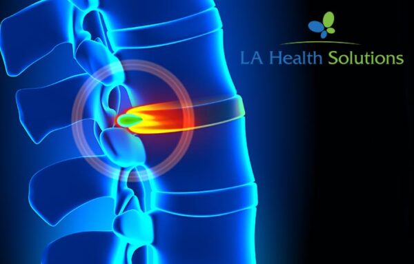 Bulging Disc & Artificial Disc Replacement | LA Health Solutions