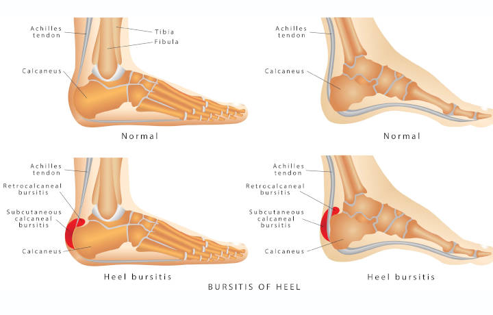 What Is Bursitis? – LA Health Solutions