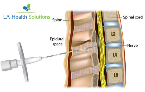 Epidural Steroid Injection Treatment La Health Solutions