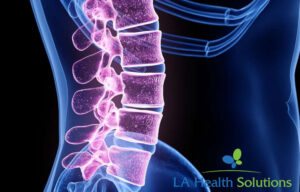 Lumbar Transforaminal Epidural Steroid Injection (Image of Spine)