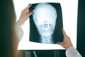 Traumatic Brain Injury x-ray